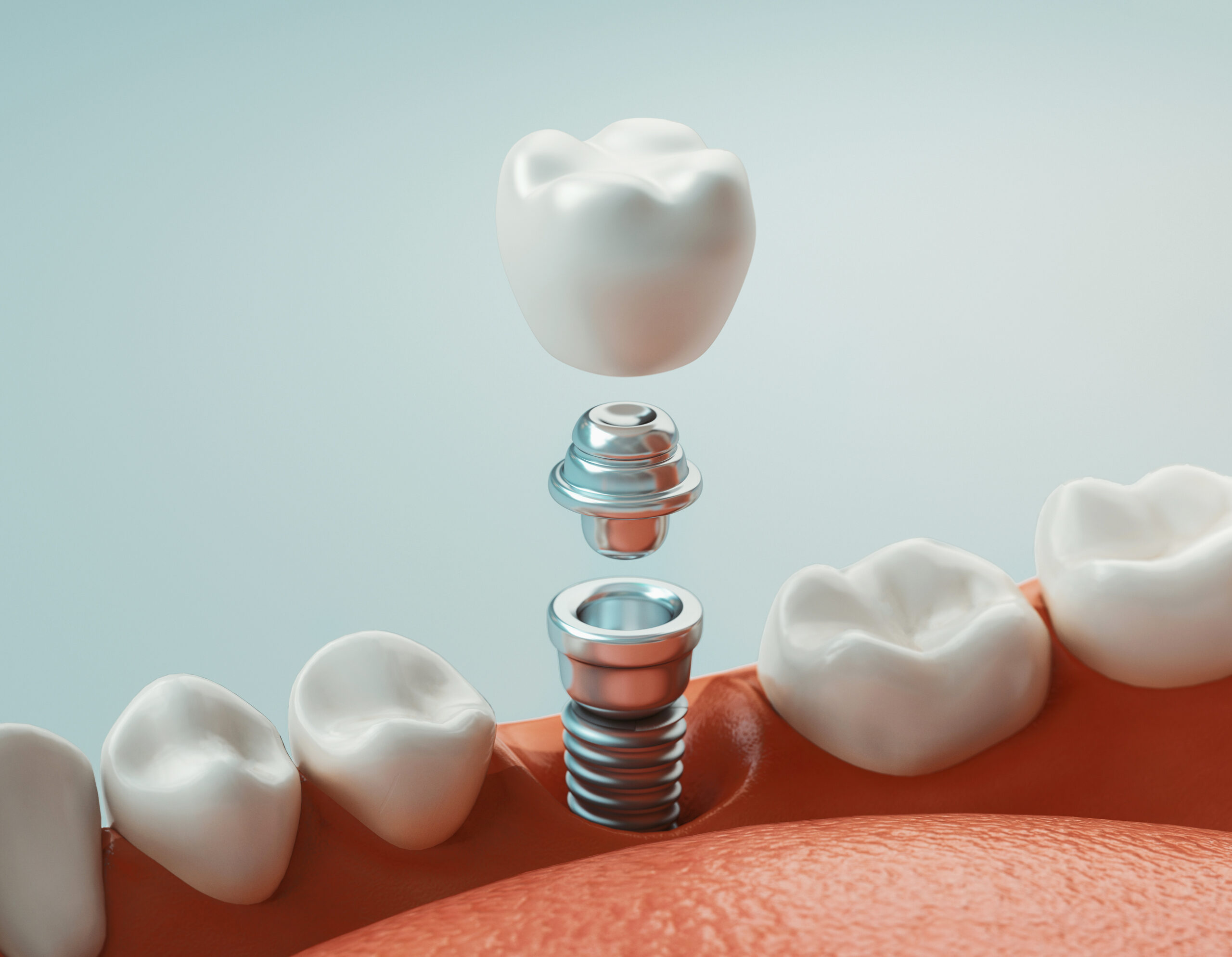 All-on-4 Implants | Dental Implants Dartford | Dentist Crayford